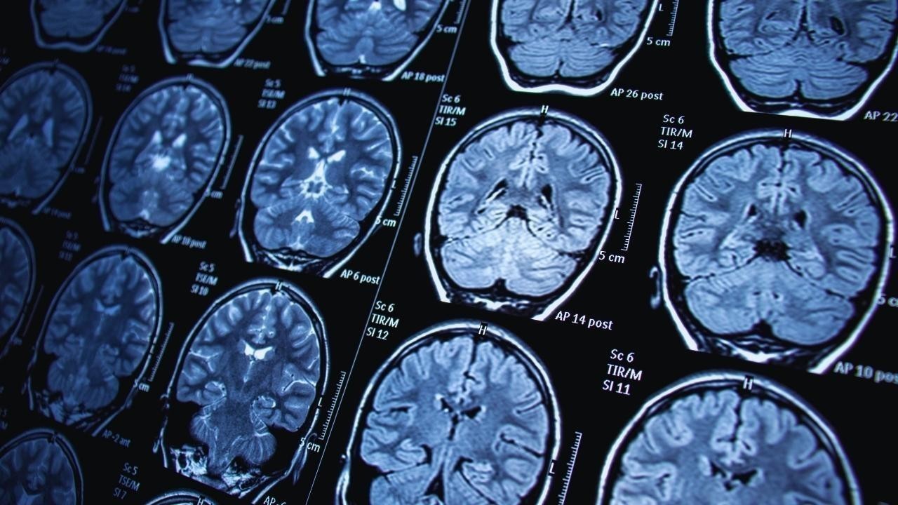 NeuroTech 2025: The Rise of Brain-Computer Interfaces from Rehab to Reality