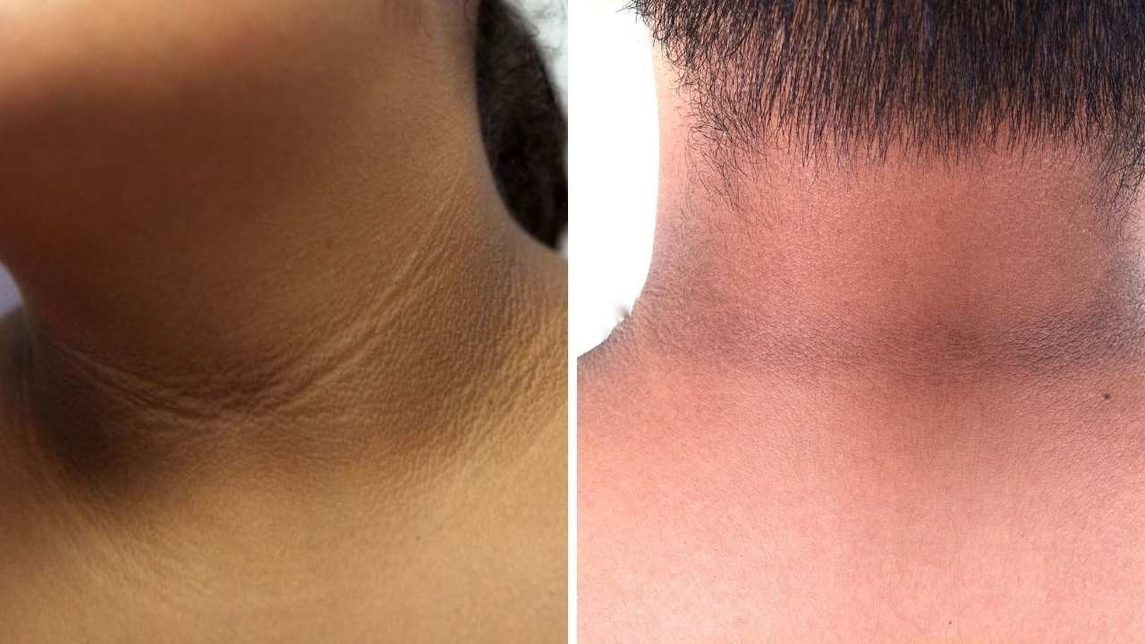 8 Home Remedies to Get Rid of Dark Neck Naturally